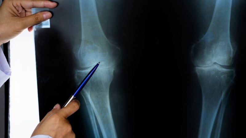 整形外科の膝のレントゲン画像